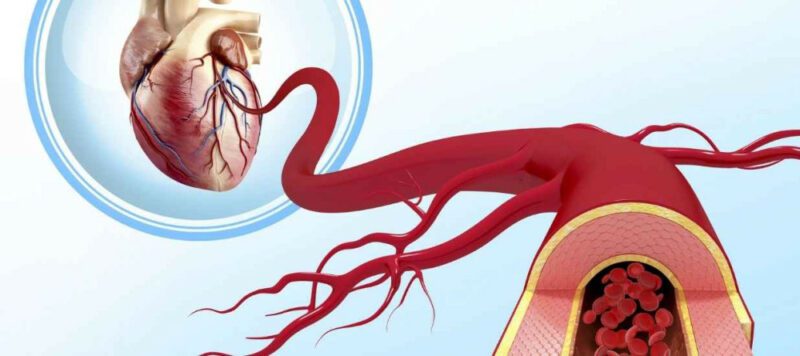 Ana Koroner Arter Hastalarina Gi 1 Yeni Anasayfa