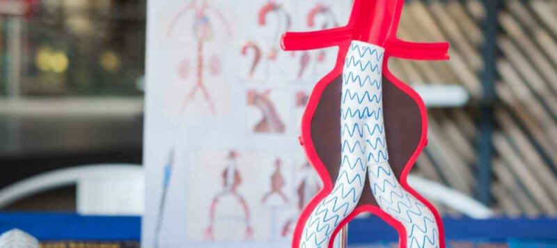 Aort Anevrizmasi Aort Anevrizması Nedir? Belirtileri, Nedenleri ve Tedavisi Aort Anevrizmasi Aort Anevrizması Nedir? Belirtileri, Nedenleri ve Tedavisi