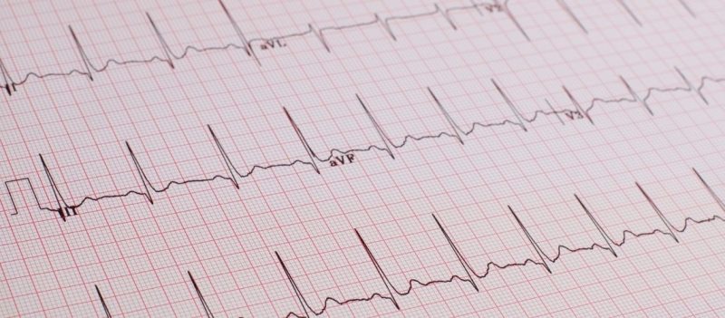 EKG Ile Kalp Yetmezligi Tespit Edilebilir Mi EKG İle Kalp Yetmezliği Tespit Edilebilir Mi? EKG Ile Kalp Yetmezligi Tespit Edilebilir Mi EKG İle Kalp Yetmezliği Tespit Edilebilir Mi?