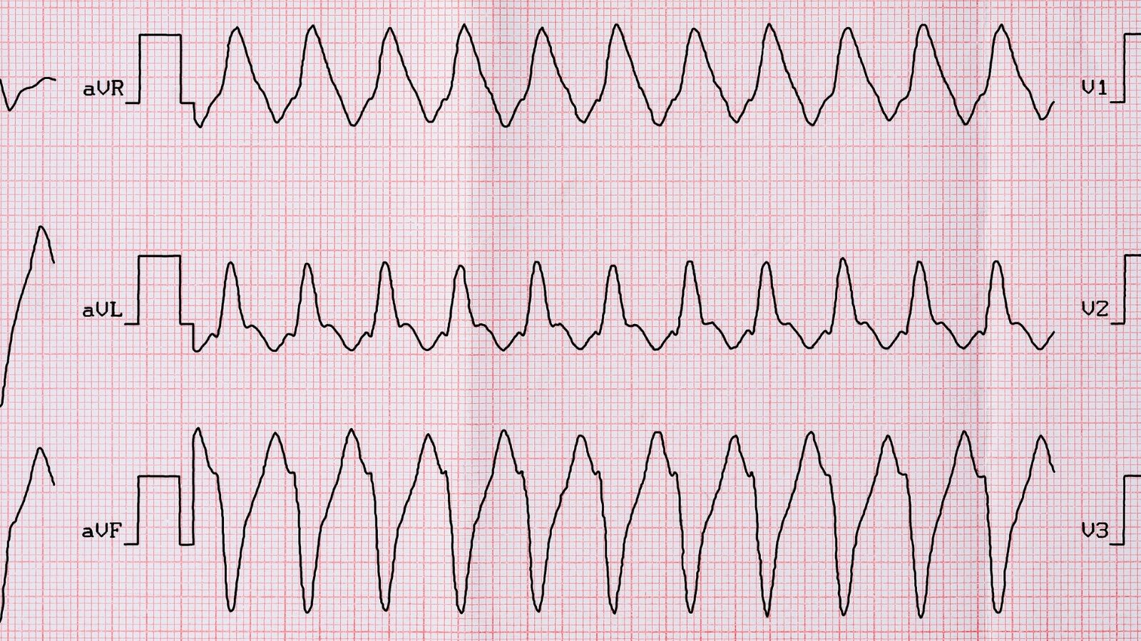 Atrial Flutter Nedir Atrial Flutter Nedir?