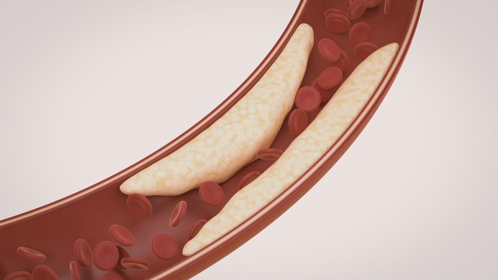 Dislipidemi Dislipidemi