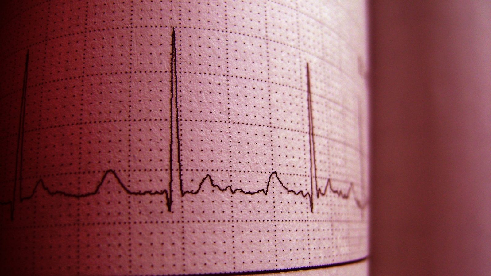 Uzun QT Sendromu Uzun QT Sendromu