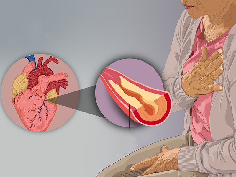 Koroner Arter Hastalığının Tedavi Seçenekleri